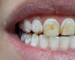 Эрозия зубной эмали: основные факторы риска и эффективное лечение